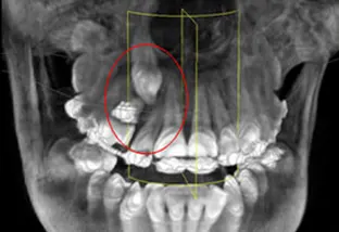 denticolo sovranumerario OPT