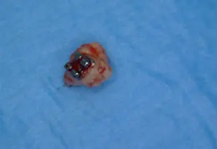 Odontoma