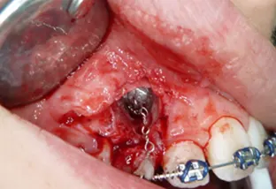 Odontoma