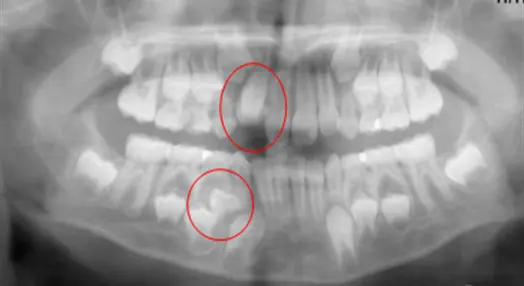 Orto pan tomografia riscontro dentale