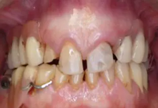 denti vista frontale