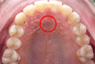 Terapia miofunzionale della lingua vista palato