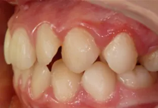 Terapia miofunzionale della lingua vista sx