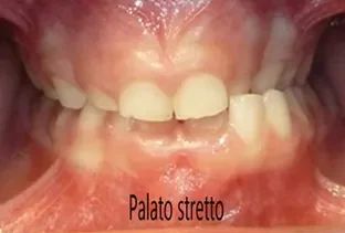 Terapia miofunzionale della lingua palato stretto