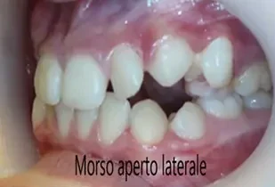 Terapia miofunzionale della lingua morso aperto laterale