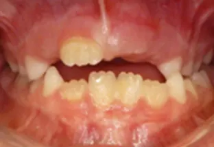 Scopri di più sull'articolo Terapia miofunzionale della lingua