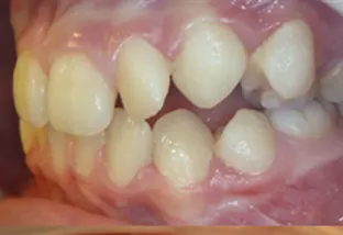 Terapia miofunzionale della lingua vista sx