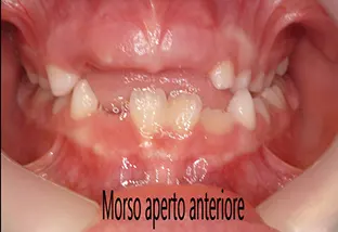Terapia miofunzionale della lingua Morso aperto anteriore
