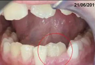 Fusione dentale e il dente bigemino lato sx