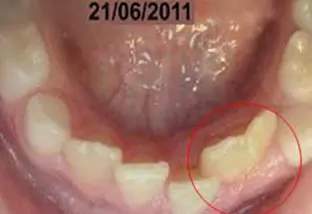 Fusione dentale e il dente bigemino vista pavimento orale