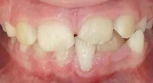 Fusione dentale e il dente bigemino vista frontale