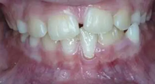 Fusione dentale e il dente bigemino vista frontale