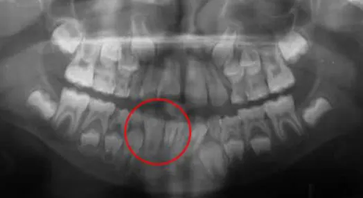 Fusione dentale e il dente bigemino panoramica