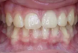 Fusione dentale e il dente bigemino fase finale vista frontale